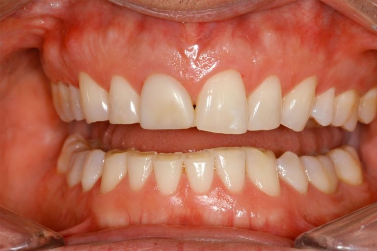 vancouver teeth grinding