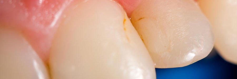 coquitlam teeth discoloration