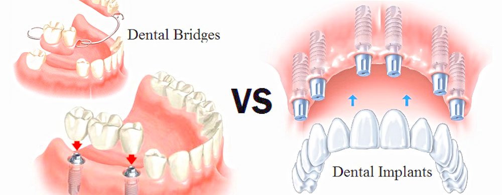vancouver dental implants bridges dentures